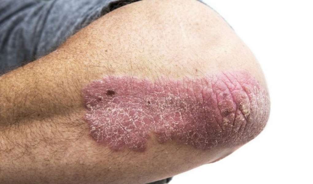 Discoid lupus erythematosus - Hình ảnh minh họa